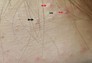 acne1.jpg