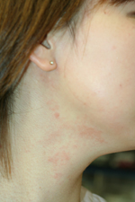 dryness_neck1.jpg