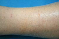 eczema1.jpg