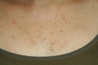 malasezziafolliculitis.jpg