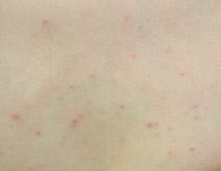 malasseziafolliculitis.jpg