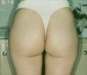 meso-buttock-pre.jpg