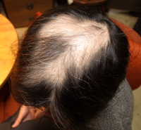 premesoalopecia.jpg