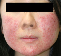 rosasea-like-dermatitis.jpg